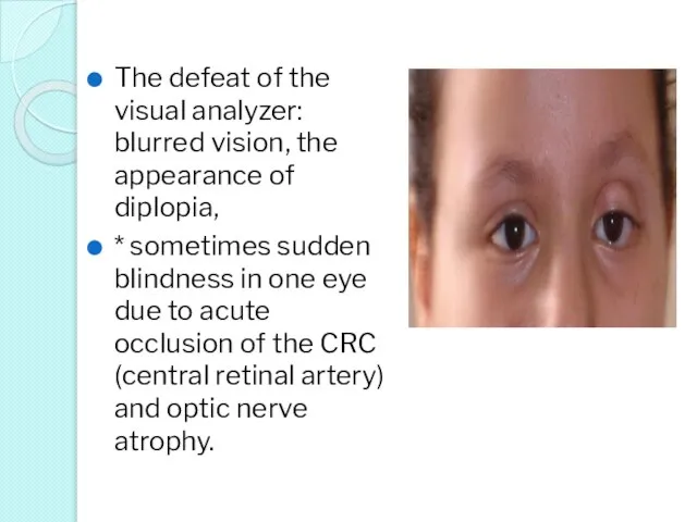 The defeat of the visual analyzer: blurred vision, the appearance of