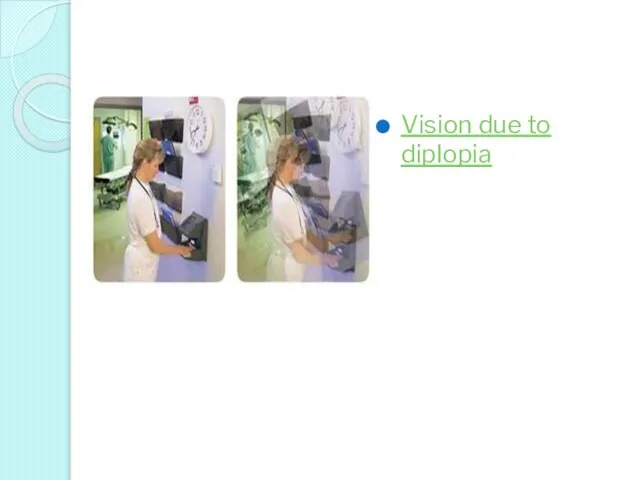 Vision due to diplopia