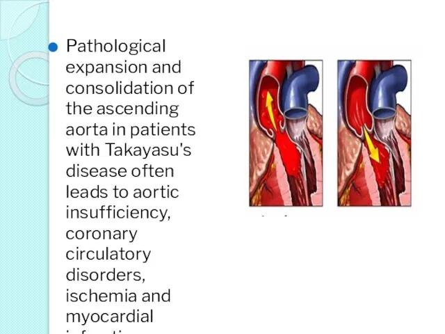 Pathological expansion and consolidation of the ascending aorta in patients with