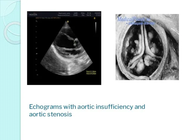 Echograms with aortic insufficiency and aortic stenosis