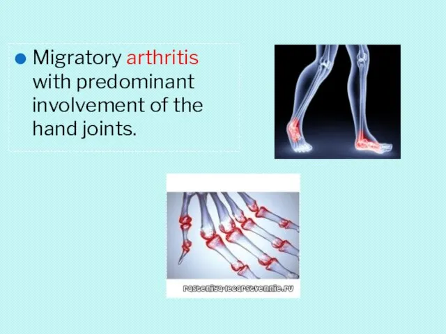 Migratory arthritis with predominant involvement of the hand joints.