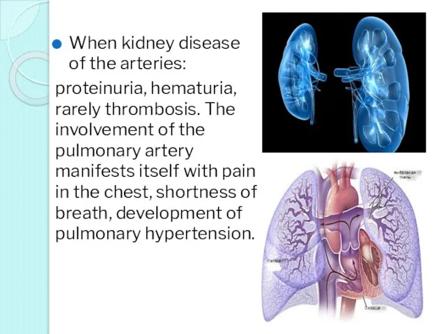 When kidney disease of the arteries: proteinuria, hematuria, rarely thrombosis. The