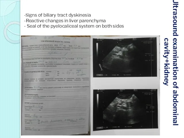 Ultrasound examination of abdominal cavity+kidney -Signs of biliary tract dyskinesia -Reactive