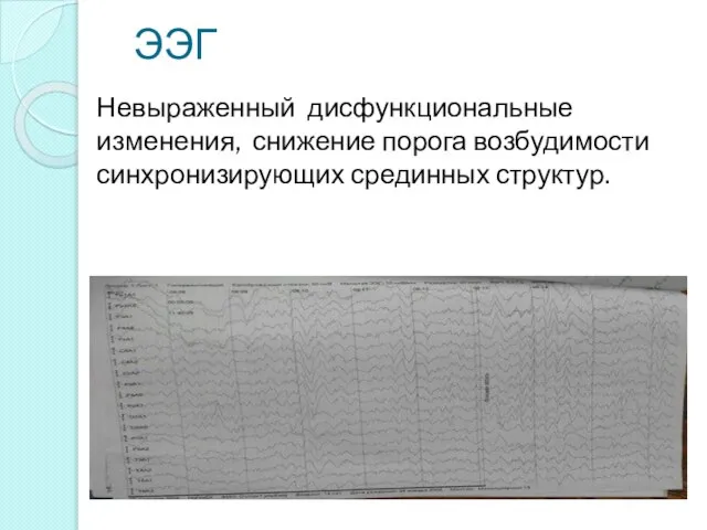 Невыраженный дисфункциональные изменения, снижение порога возбудимости синхронизирующих срединных структур. ЭЭГ