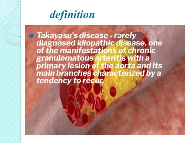 definition Takayasu's disease - rarely diagnosed idiopathic disease, one of the