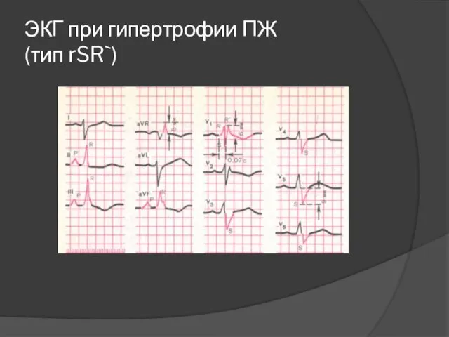 ЭКГ при гипертрофии ПЖ (тип rSR`)