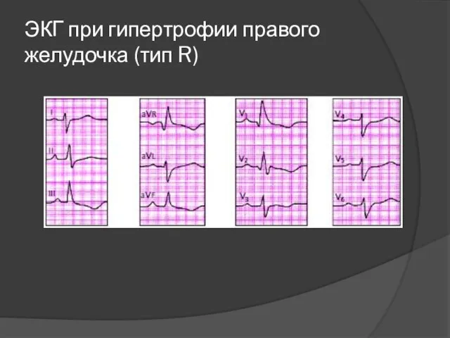 ЭКГ при гипертрофии правого желудочка (тип R)