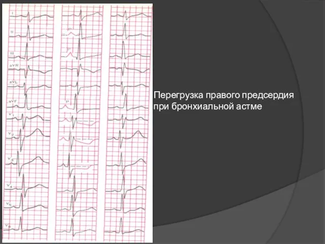 Перегрузка правого предсердия при бронхиальной астме