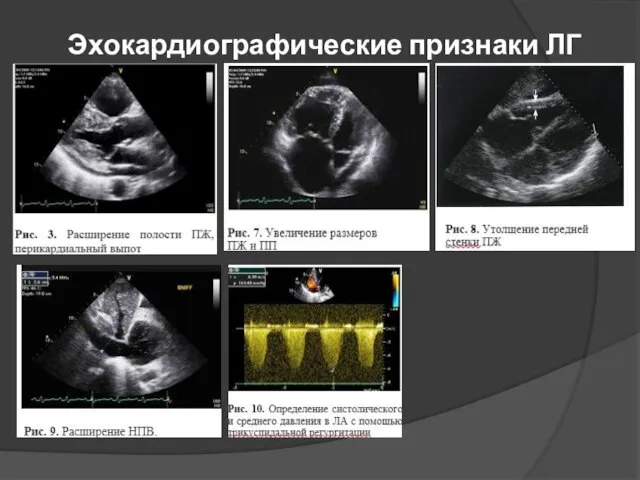 Эхокардиографические признаки ЛГ