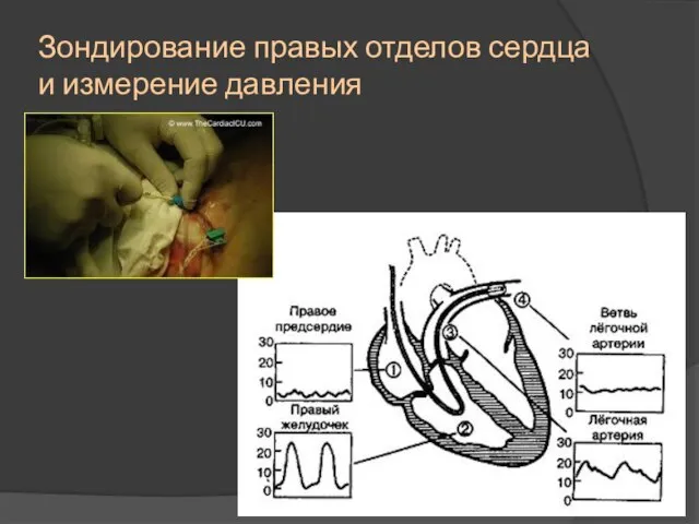 Зондирование правых отделов сердца и измерение давления