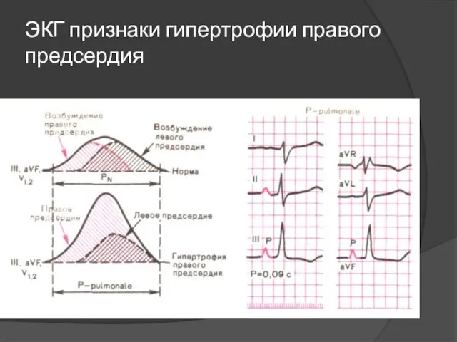 ЭКГ признаки гипертрофии правого предсердия