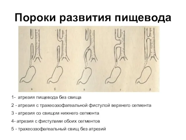 Пороки развития пищевода 1- атрезия пищевода без свища 2 - атрезия