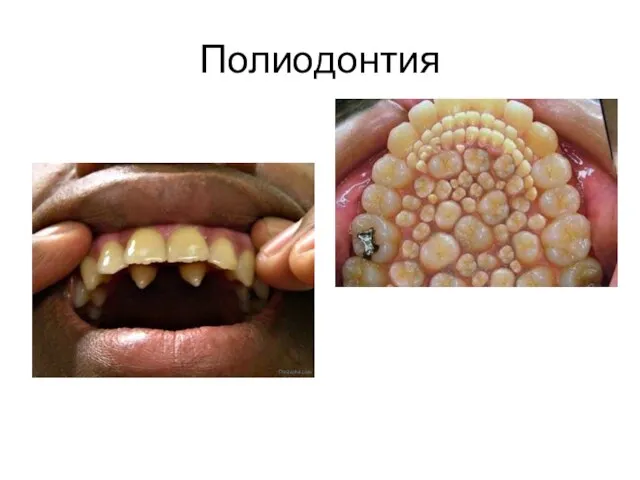 Полиодонтия