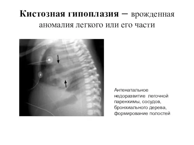 Кистозная гипоплазия – врожденная аномалия легкого или его части Антенатальное недоразвитие