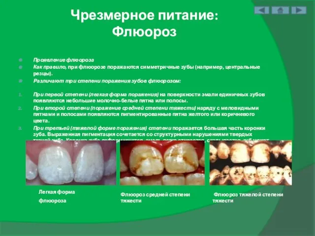 Чрезмерное питание: Флюороз Проявление флюороза Как правило, при флюорозе поражаются симметричные