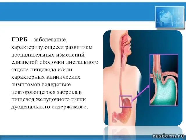 ГЭРБ – заболевание, характеризующееся развитием воспалительных изменений слизистой оболочки дистального отдела