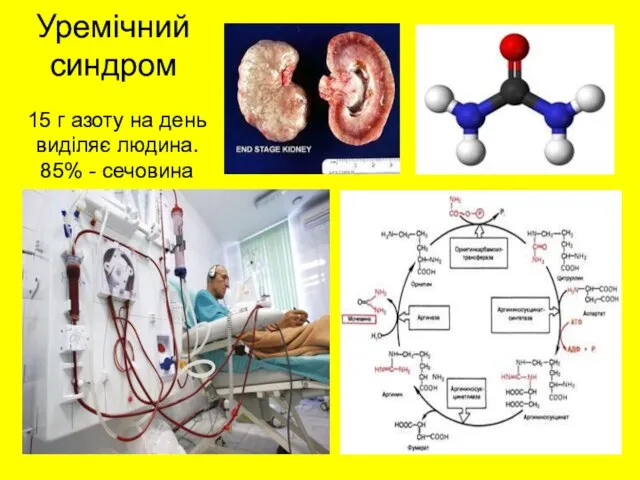 Уремічний синдром 15 г азоту на день виділяє людина. 85% - сечовина