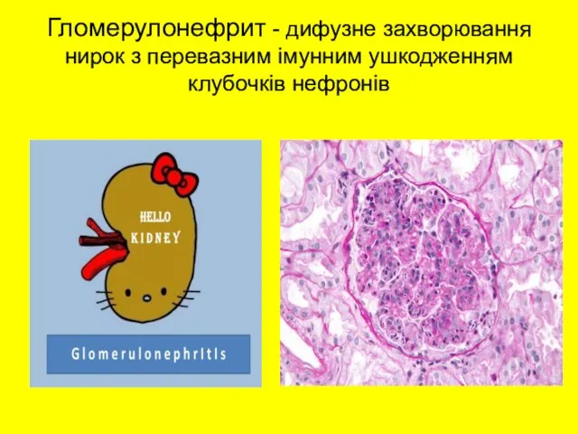 Гломерулонефрит - дифузне захворювання нирок з перевазним імунним ушкодженням клубочків нефронів