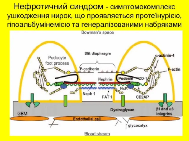 Нефротичний синдром - симптомокомплекс ушкодження нирок, що проявляється протеїнурією, гіпоальбумінемією та генералізованими набряками