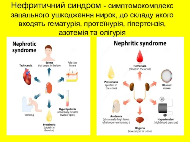 Нефритичний синдром - симптомокомплекс запального ушкодження нирок, до складу якого входять