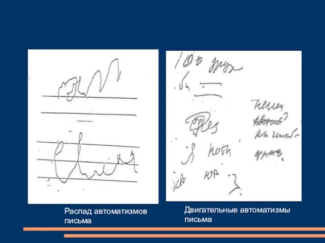 Распад автоматизмов письма Двигательные автоматизмы письма