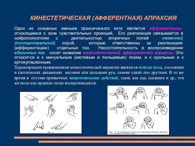 КИНЕСТЕТИЧЕСКАЯ (АФФЕРЕНТНАЯ) АПРАКСИЯ Одно из основных звеньев праксического акта является афферентным,