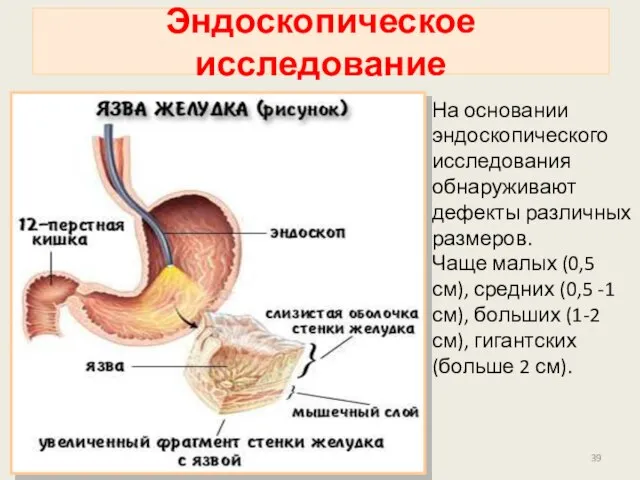 Эндоскопическое исследование На основании эндоскопического исследования обнаруживают дефекты различных размеров. Чаще