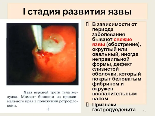 В зависимости от периода заболевания бывают свежие язвы (обострение), округлый или