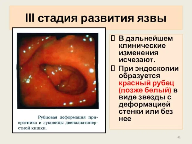 ІІІ стадия развития язвы В дальнейшем клинические изменения исчезают. При эндоскопии