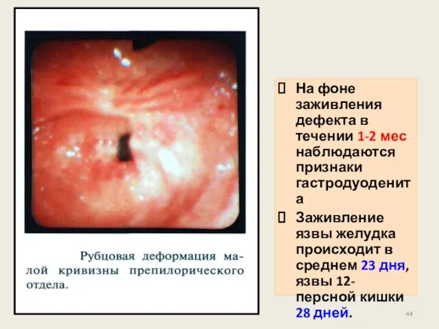 На фоне заживления дефекта в течении 1-2 мес наблюдаются признаки гастродуоденита