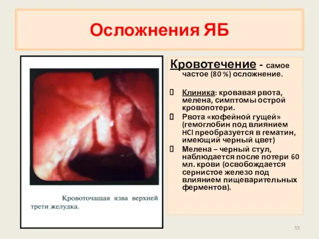 Осложнения ЯБ Кровотечение - самое частое (80 %) осложнение. Клиника: кровавая