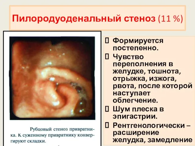 Пилородуоденальный стеноз (11 %) Формируется постепенно. Чувство переполнения в желудке, тошнота,