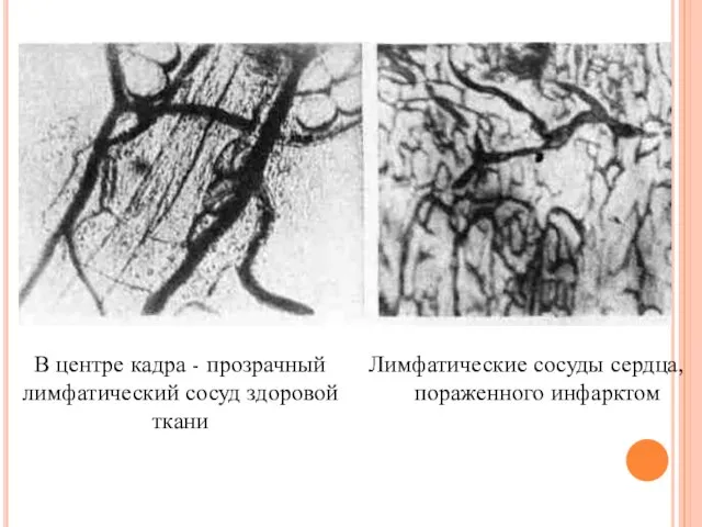 В центре кадра - прозрачный лимфатический сосуд здоровой ткани Лимфатические сосуды сердца, пораженного инфарктом