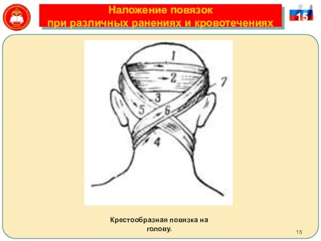Наложение повязок при различных ранениях и кровотечениях 15 Крестообразная повязка на голову.