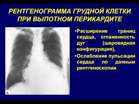 РЕНТГЕНОГРАММА ГРУДНОЙ КЛЕТКИ ПРИ ВЫПОТНОМ ПЕРИКАРДИТЕ Расширение границ сердца, сглаженность дуг