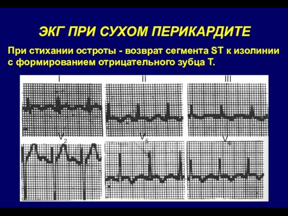 ЭКГ ПРИ СУХОМ ПЕРИКАРДИТЕ При стихании остроты - возврат сегмента ST