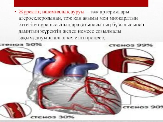 Жүректің ишемиялық ауруы – тәж артериялары атеросклерозынан, тәж қан ағымы мен