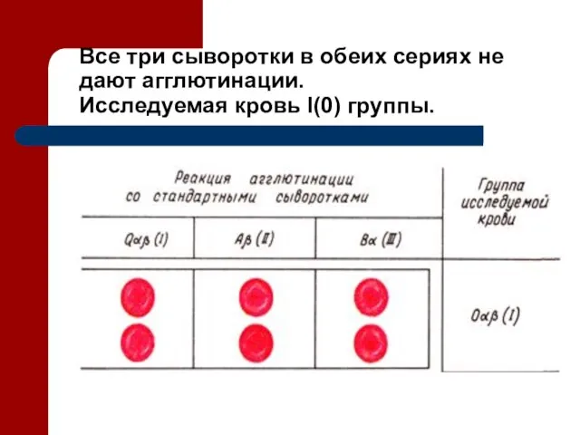 Все три сыворотки в обеих сериях не дают агглютинации. Исследуемая кровь I(0) группы.