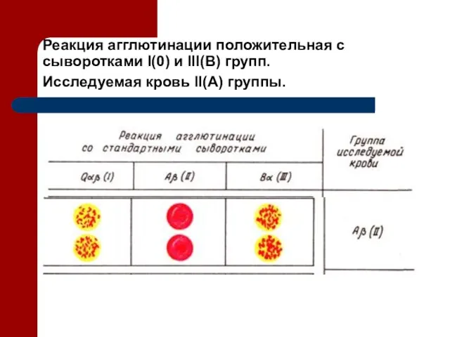 Реакция агглютинации положительная с сыворотками I(0) и III(В) групп. Исследуемая кровь II(А) группы.