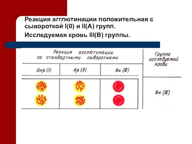 Реакция агглютинации положительная с сывороткой I(0) и II(А) групп. Исследуемая кровь III(В) группы.