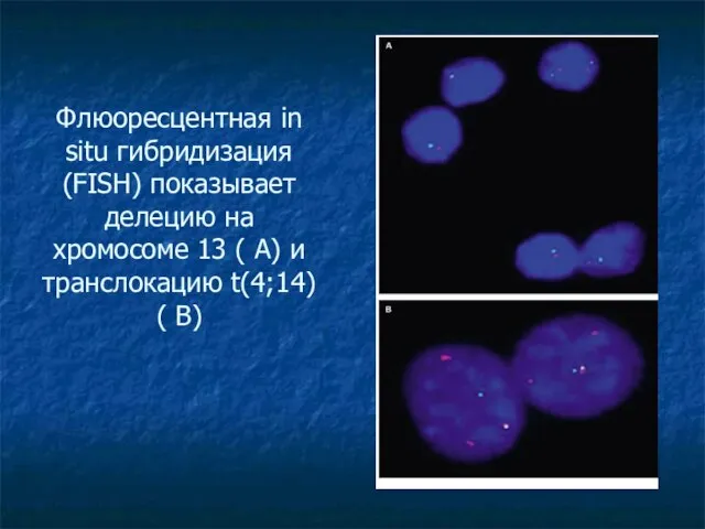 Флюоресцентная in situ гибридизация (FISH) показывает делецию на хромосоме 13 (