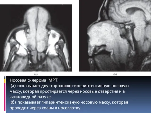 Носовая склерома. МРТ. (a) показывает двустороннюю гиперинтенсивную носовую массу, которая простирается