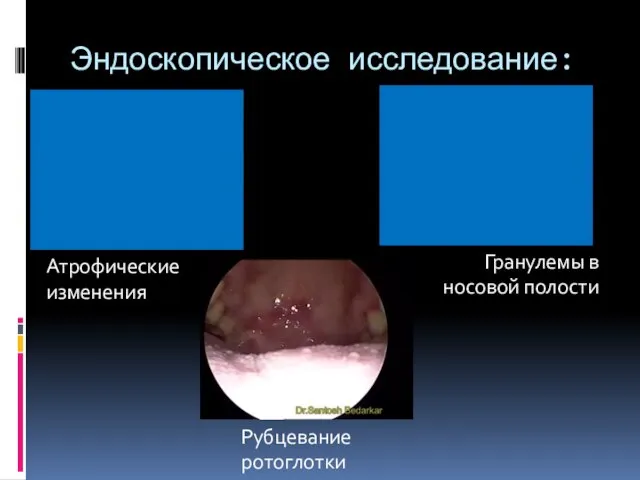 Эндоскопическое исследование: Рубцевание ротоглотки Атрофические изменения Гранулемы в носовой полости