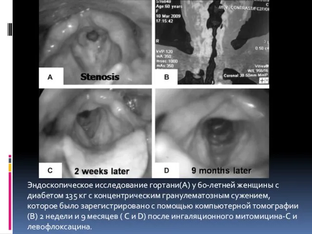 Эндоскопическое исследование гортани(А) у 60-летней женщины с диабетом 135 кг с