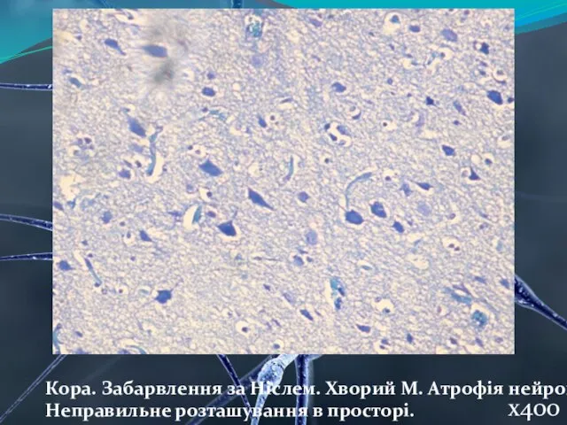 Кора. Забарвлення за Ніслем. Хворий М. Атрофія нейронів. Неправильне розташування в просторі. х400