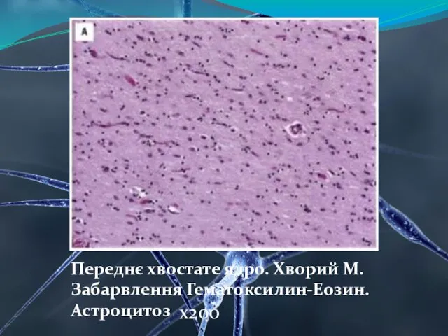 Переднє хвостате ядро. Хворий М. Забарвлення Гематоксилин-Еозин. Астроцитоз х200