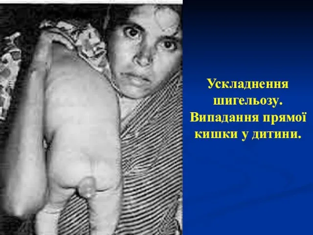 Ускладнення шигельозу. Випадання прямої кишки у дитини.