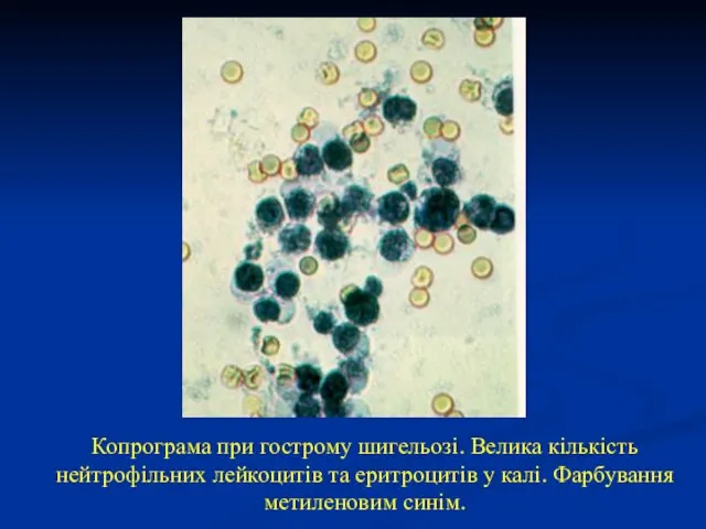 Копрограма при гострому шигельозі. Велика кількість нейтрофільних лейкоцитів та еритроцитів у калі. Фарбування метиленовим синім.