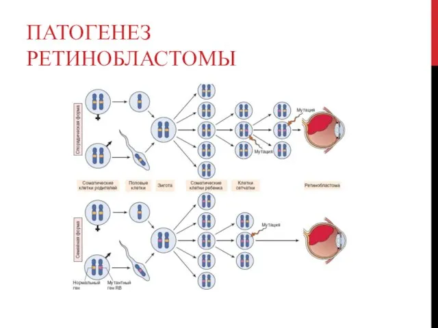 ПАТОГЕНЕЗ РЕТИНОБЛАСТОМЫ