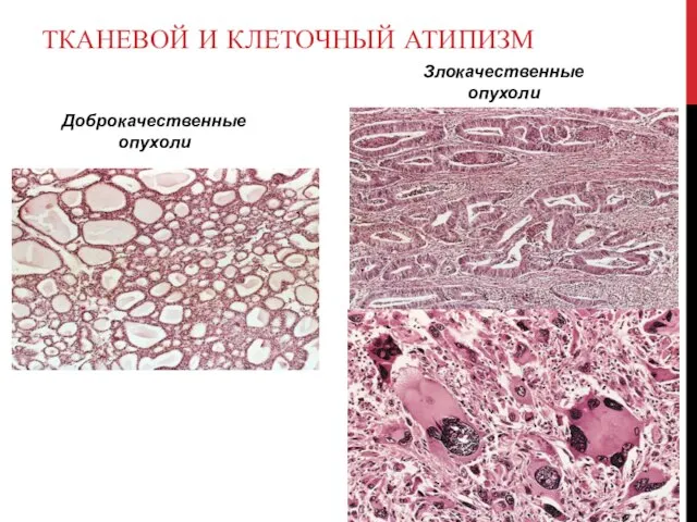 ТКАНЕВОЙ И КЛЕТОЧНЫЙ АТИПИЗМ Доброкачественные опухоли Злокачественные опухоли